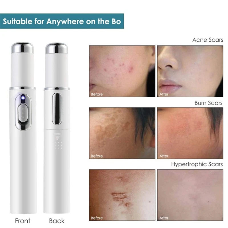 BLUE LIGHT ACNE THERAPY